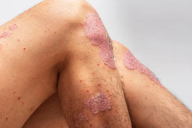 Chronic or Recurring Psoriasis
