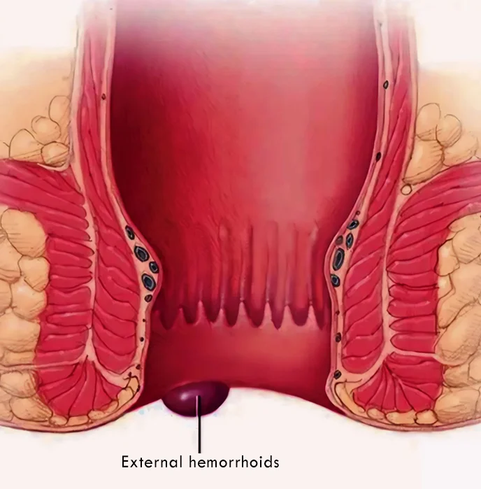 Allergic Rhinitis & Sinusitis