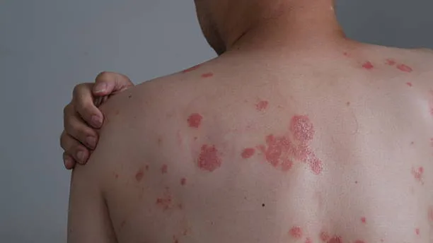 Guttate Psoriasis