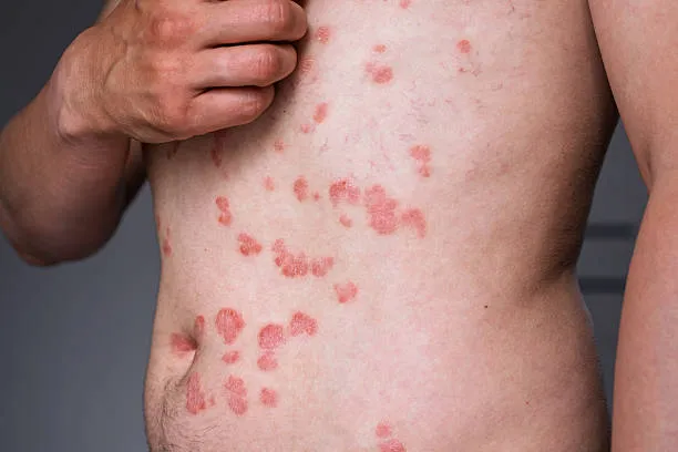 Inverse Psoriasis