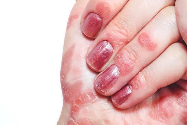 Nail Psoriasis