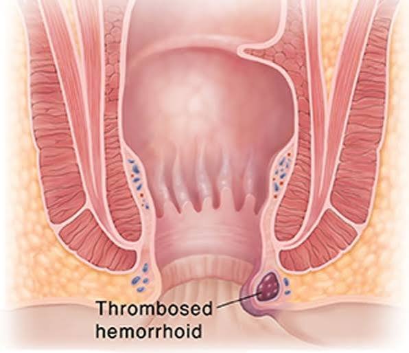 Recurrent Cough & Cold