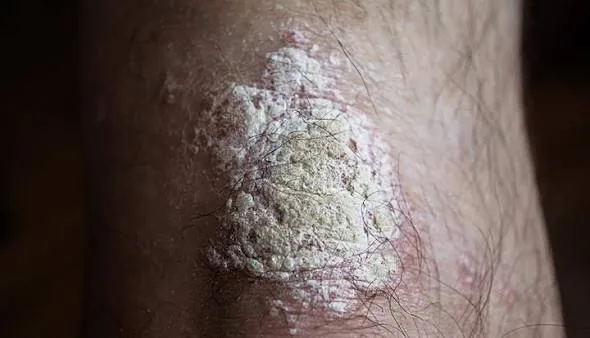 Plaque Psoriasis