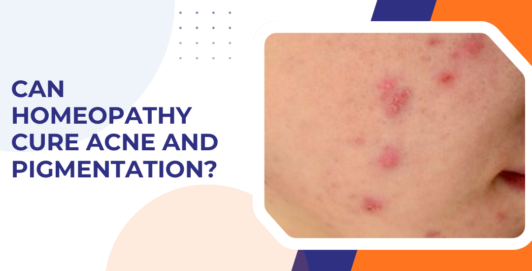 Can Homeopathy Cure Acne and Pigmentation?