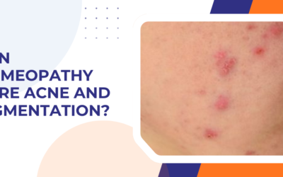 Can Homeopathy Cure Acne and Pigmentation?
